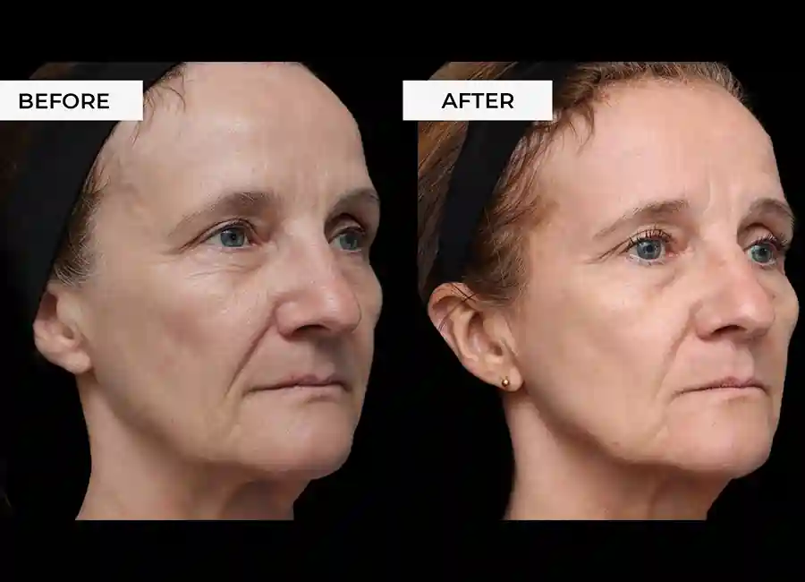 How Many RF Microneedling Sessions Will You Need to See a Difference Nuneaton?