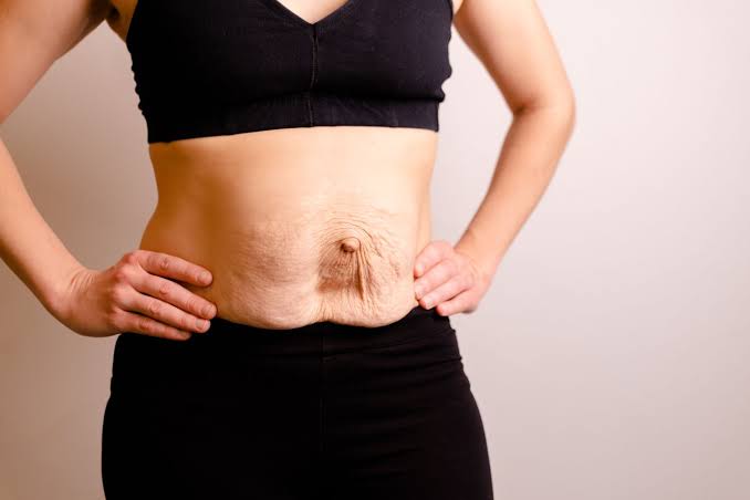Is Surgery Really the Only Way to Repair Diastasis Recti Nuneaton?