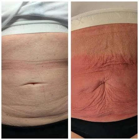 How Does RF Microneedling Improve Crepey, Thin and Uneven Skin Texture Nuneaton?