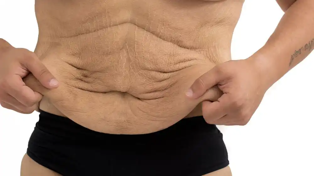 RF Microneedling for Loose Skin: How Can It Help Tighten and Reshape the Skin Nuneaton?